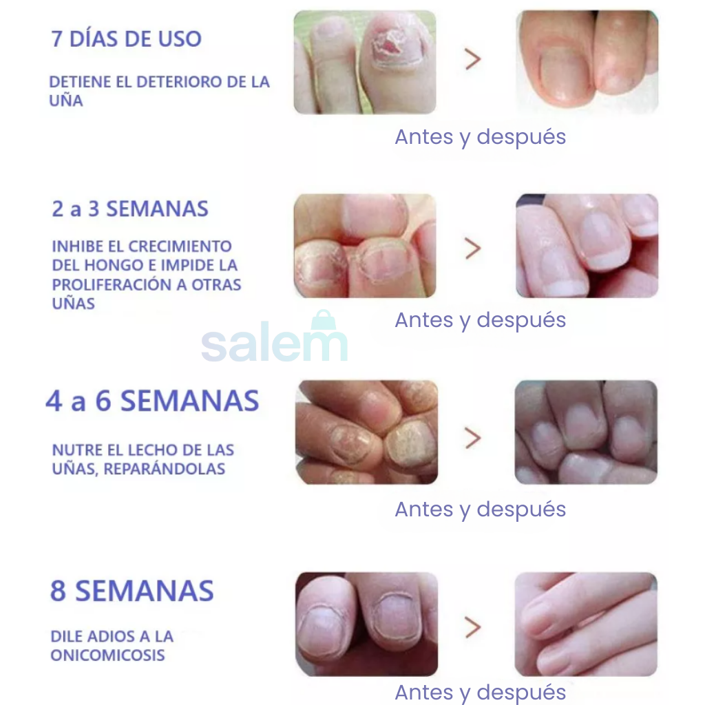 PARCHE PARA HONGOS